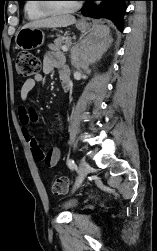Adrenal lymphoma (Radiopaedia 73730-84529 Sagittal C+ portal venous phase 69).jpg
