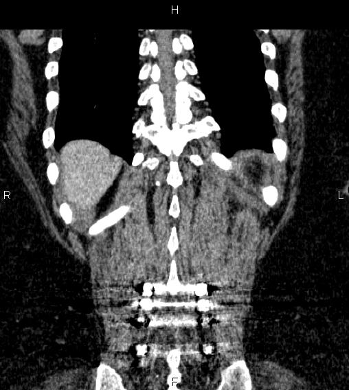 Adrenal myelolipoma (Radiopaedia 84319-99617 Coronal renal cortical phase 68).jpg
