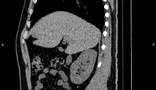 File:Adrenal myelolipoma (Radiopaedia 84321-99619 Sagittal non-contrast 32).jpg