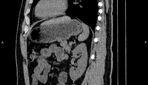File:Adrenal myelolipoma (Radiopaedia 84321-99619 Sagittal non-contrast 75).jpg