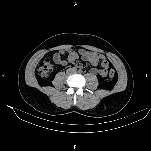 Adrenal myelolipoma (Radiopaedia 87794-104246 Axial non-contrast 62).jpg