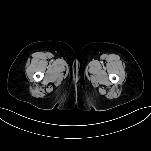 Adrenocortical carcinoma (Radiopaedia 87281-103569 Axial C+ portal venous phase 99).jpg