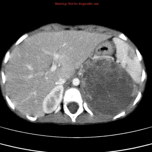 File:Adrenocortical carcinoma (Radiopaedia 9449-10131 Axial C+ portal venous phase 13).jpg