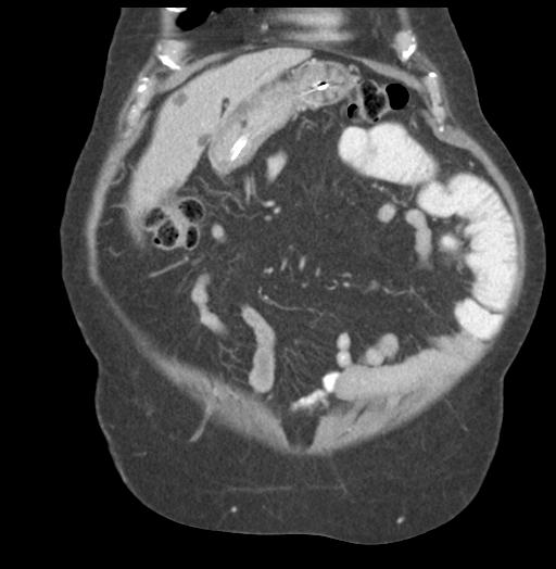 Adult ileal intussusception with secondary obstruction (Radiopaedia 30395-31051 Coronal C+ portal venous phase 16).jpg
