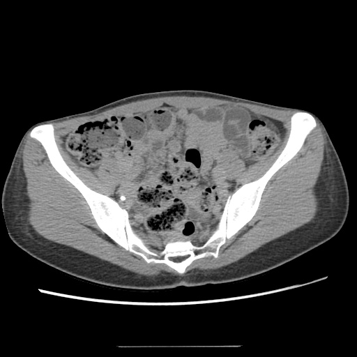 Adult polycystic kidney disease (Radiopaedia 48845-53876 Axial renal excretory phase 75).jpg
