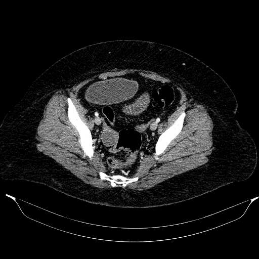 Afferent loop syndrome - secondary to incarcerated trocar site hernia (Radiopaedia 82959-97305 Axial C+ portal venous phase 198).jpg