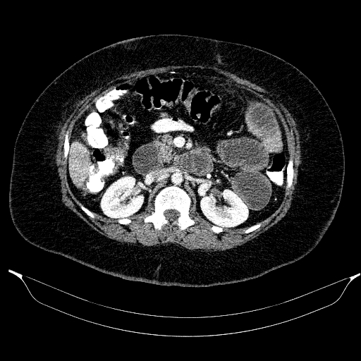 Afferent loop syndrome - secondary to incarcerated trocar site hernia (Radiopaedia 82959-97305 Axial C+ portal venous phase 96).jpg