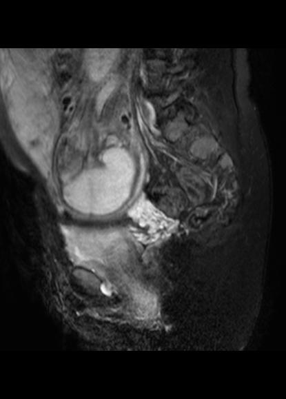 File:Aggressive angiomyxoma of the pelvis and perineum (Radiopaedia 59162-66479 Sagittal T2 fat sat 9).jpg
