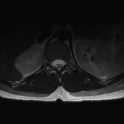 File:Aggressive vertebral hemangioma (Radiopaedia 39937-42404 Axial T2 4).png