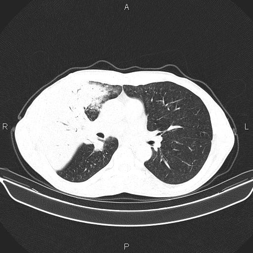 Air bronchogram in pneumonia (Radiopaedia 85719-101512 Axial lung window 33).jpg