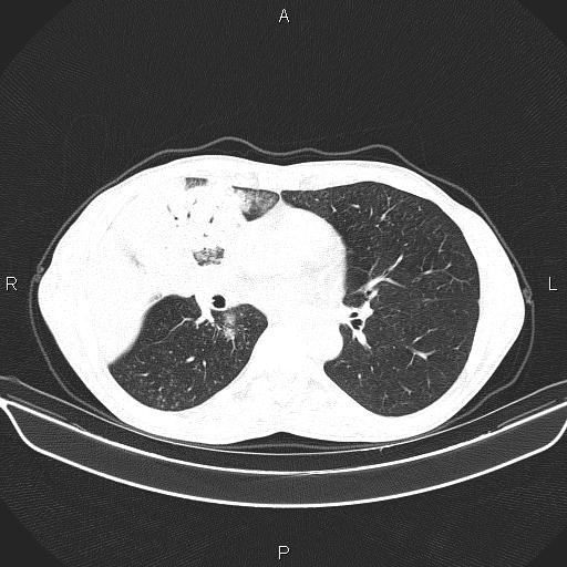 Air bronchogram in pneumonia (Radiopaedia 85719-101512 Axial lung window 36).jpg
