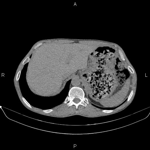 Air bronchogram in pneumonia (Radiopaedia 85719-101512 Axial non-contrast 64).jpg