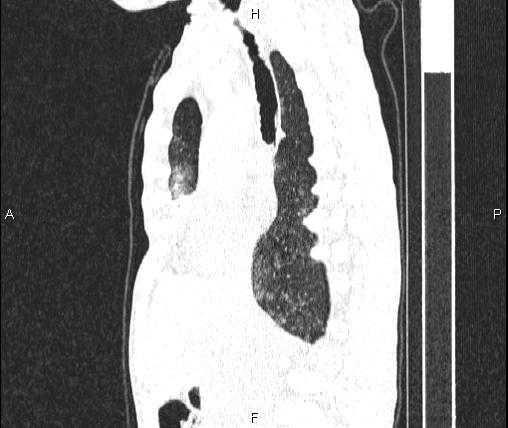 Air bronchogram in pneumonia (Radiopaedia 85719-101512 Sagittal lung window 45).jpg