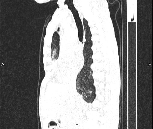 Air bronchogram in pneumonia (Radiopaedia 85719-101512 Sagittal lung window 46).jpg