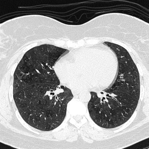 File:Air trapping in small airway disease (Radiopaedia 61685-69694 Axial lung window 100).jpg