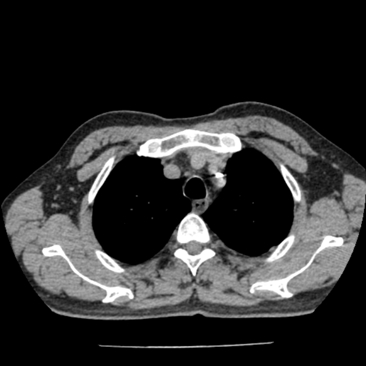 Airway foreign body in adult (Radiopaedia 85907-101779 Axial liver window 19).jpg