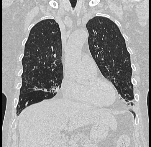 Alpha-1-antitrypsin deficiency (Radiopaedia 72058-82557 Coronal lung window 21).jpg