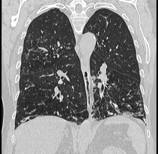 Alpha-1-antitrypsin deficiency (Radiopaedia 72058-82557 Coronal lung window 56).jpg