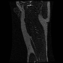 Alveolar soft part sarcoma (Radiopaedia 64501-73678 D 34).jpg