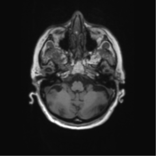 File:Alzheimer's disease (Radiopaedia 42658-45802 Axial T1 122).png