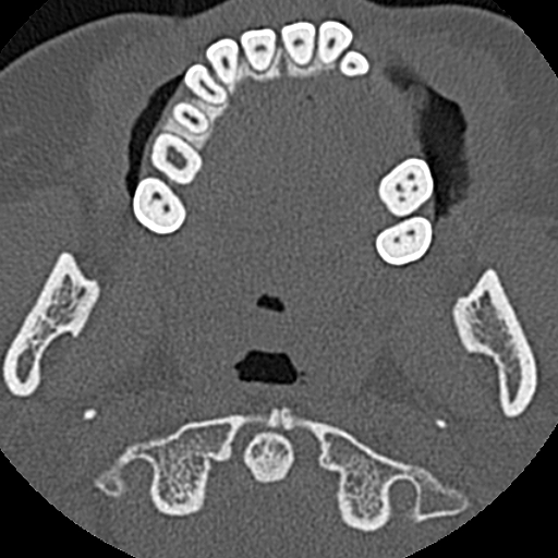 File:Ameloblastic fibro-odontoma (Radiopaedia 18843-18780 C 50).jpg