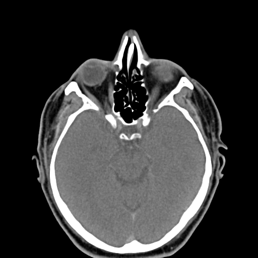 Ameloblastoma (Radiopaedia 38520-40623 Axial non-contrast 5).png