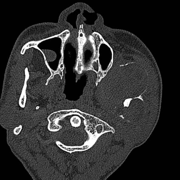 Ameloblastoma (Radiopaedia 51921-57766 Axial bone window 112).jpg