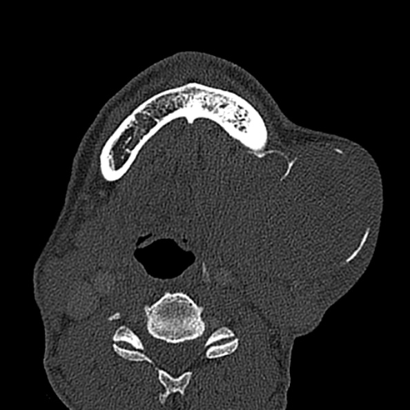 Ameloblastoma (Radiopaedia 51921-57766 Axial bone window 37).jpg