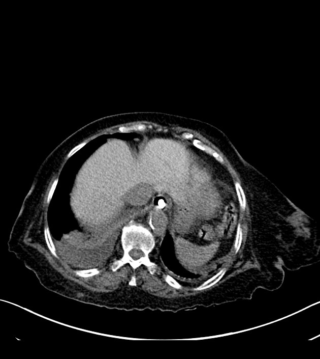 Amiodarone deposition in the liver (Radiopaedia 77587-89780 Axial non-contrast 68).jpg