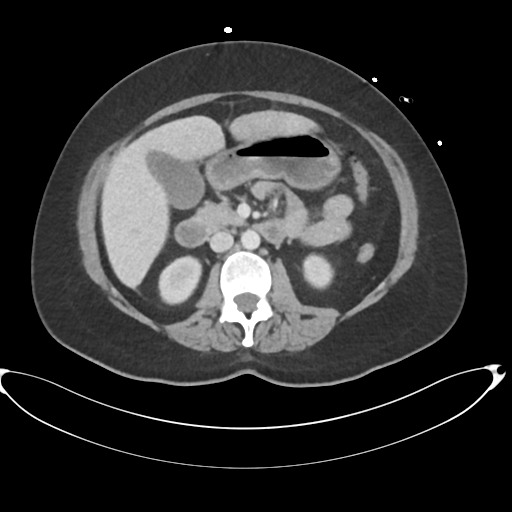 File:Amoebic liver abscess (Radiopaedia 52611-58530 A 47).png