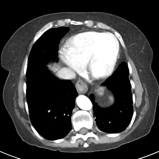 Ampullary adenocarcinoma (Radiopaedia 34013-35237 B 5).png