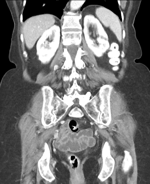 Ampullary adenocarcinoma (Radiopaedia 34013-35237 E 37).png