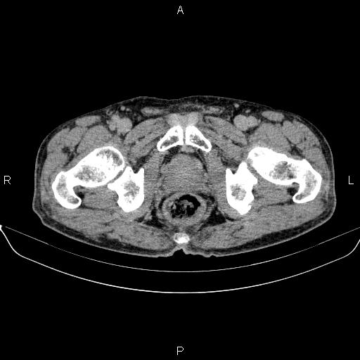 Ampullary adenocarcinoma (Radiopaedia 86093-102032 Axial C+ delayed 105).jpg