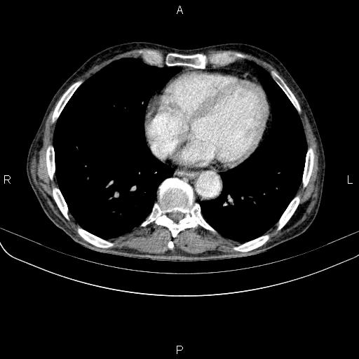 File:Ampullary adenocarcinoma (Radiopaedia 86093-102033 B 41).jpg