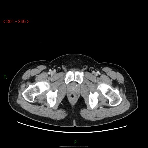 Ampullary carcinoma (Radiopaedia 56396-63056 C 104).jpg