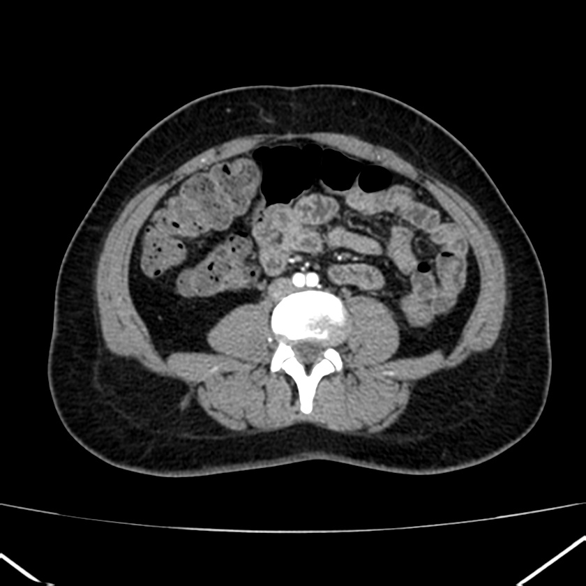 Ampullary tumor (Radiopaedia 22787-22816 B 54).jpg