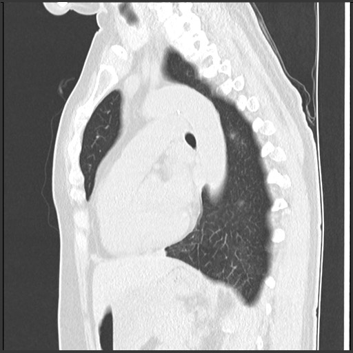 Amyloidosis - bronchial and diffuse nodular pulmonary involvement (Radiopaedia 60156-67744 F 33).jpg