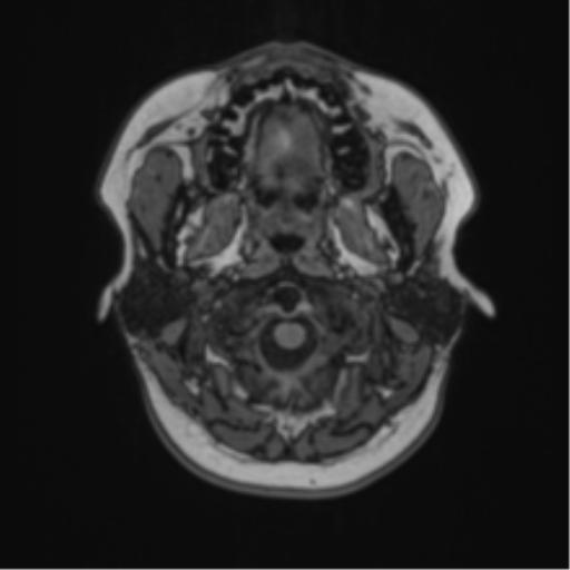 Anaplastic astroblastoma (Radiopaedia 55666-62194 Axial T1 3).png