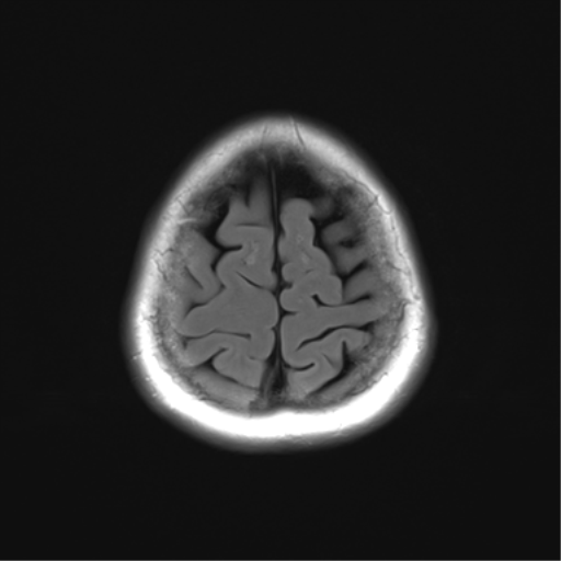 File:Anaplastic astrocytoma (Radiopaedia 86943-103160 Axial FLAIR 25).png