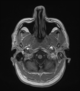Anaplastic astrocytoma IDH wild-type (Radiopaedia 49984-55273 Axial T1 8).png