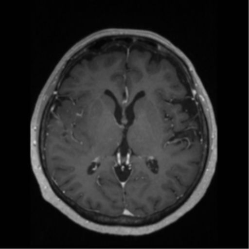 File:Anaplastic astrocytoma IDH wild-type (pseudoprogression) (Radiopaedia 42209-45276 Axial T1 C+ 80).png