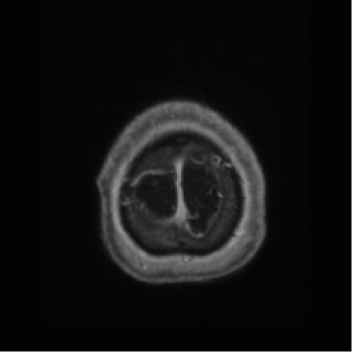 Anaplastic astrocytoma IDH wild-type (pseudoprogression) (Radiopaedia 42209-45277 Axial T1 C+ 125).png