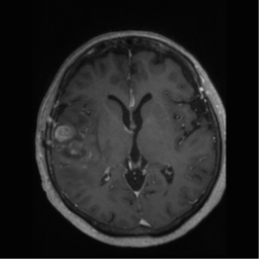 File:Anaplastic astrocytoma IDH wild-type (pseudoprogression) (Radiopaedia 42209-45277 Axial T1 C+ 64).png