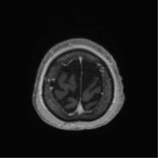 Anaplastic astrocytoma IDH wild-type (pseudoprogression) (Radiopaedia 42209-45278 Axial T1 C+ 138).png