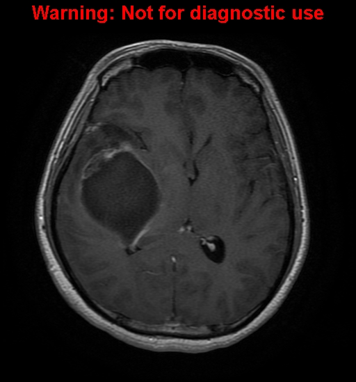 File:Anaplastic ganglioglioma (Radiopaedia 44921-48831 Axial T1 C+ 17).jpg