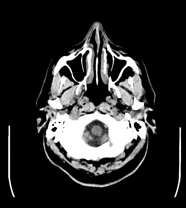 Anaplastic oligodendroglioma (Radiopaedia 79571-92753 Axial non-contrast 9).jpg