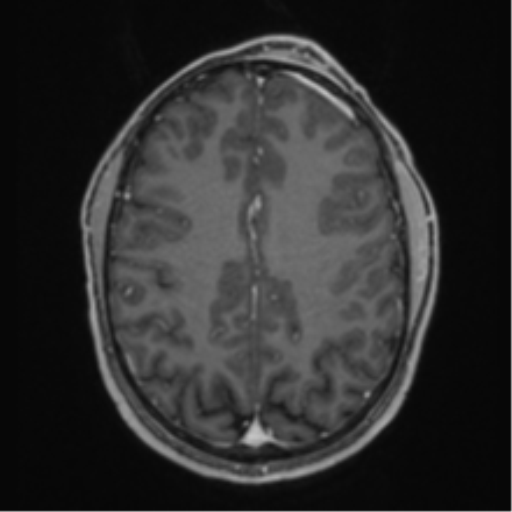 Anaplastic oligodendroglioma with skull fracture (Radiopaedia 74831-85845 Axial T1 C+ fat sat 44).png