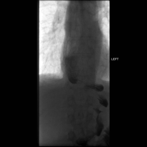 File:Anastomotic stricture post Ivor Lewis esophagectomy (Radiopaedia 47937-52715 C 23).png