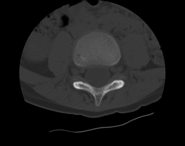 Aneurysmal bone cyst - sacrum (Radiopaedia 65190-74195 Axial bone window 3).jpg