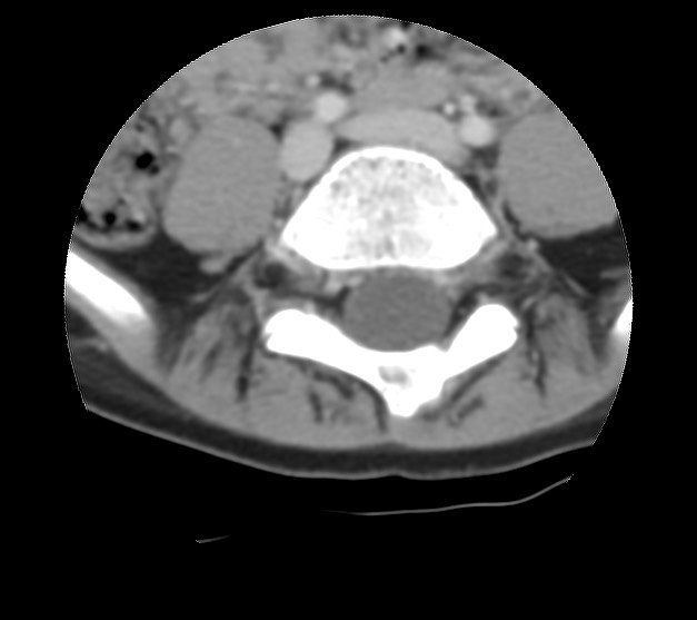 Aneurysmal bone cyst - sacrum (Radiopaedia 65190-74195 Axial non-contrast 11).jpg